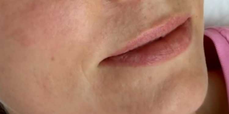 Preenchimento labial Antes